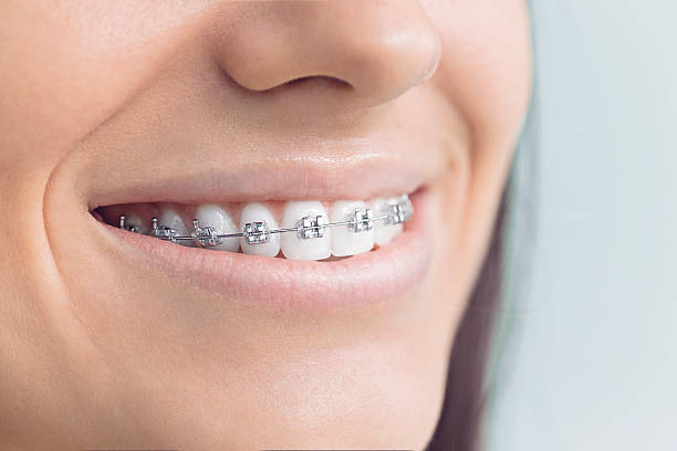 Best Traditional Braces  in Riverdale, GA